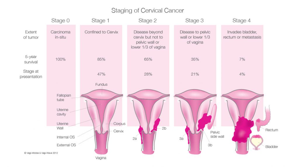 Cervical Cancer Vagi Wave 